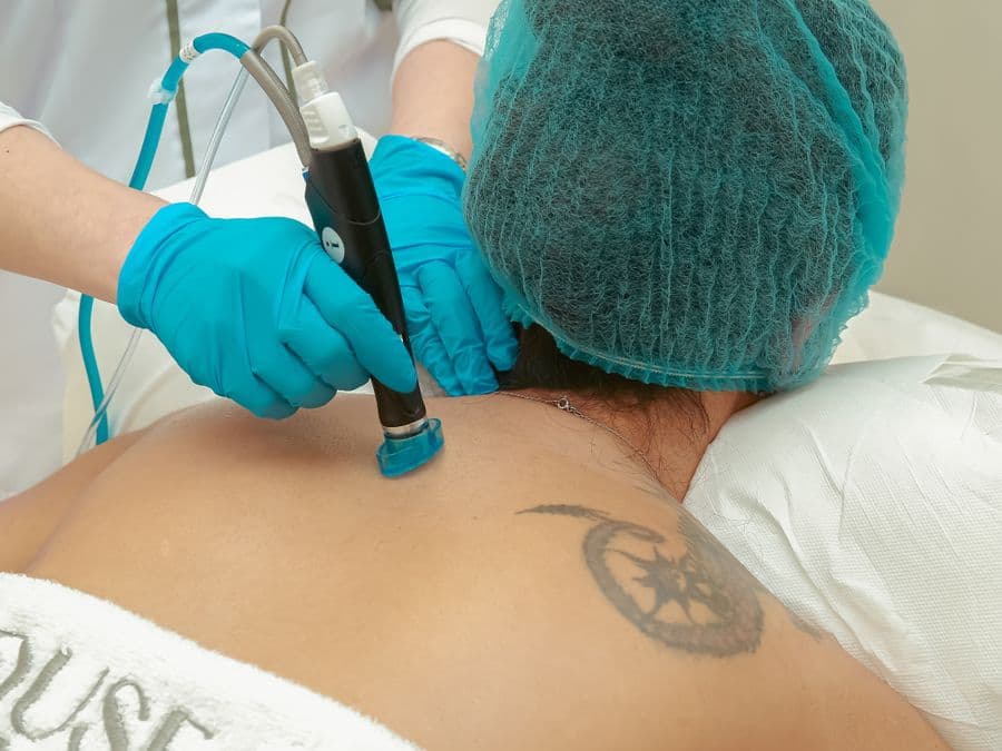 Laser tattoo removal session