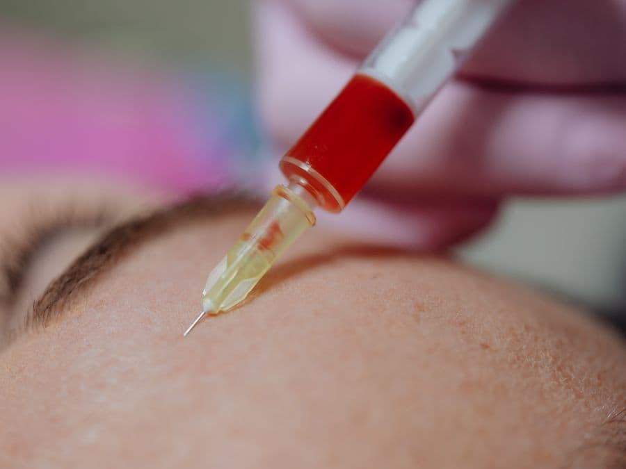 Scalp mesotherapy treatment session